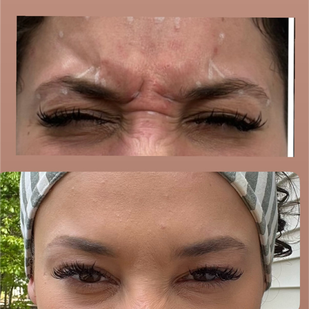 Botox/Dysport/JEUVEAU/Daxxify at Nueva Vida Medspa in Audubon, NJ
