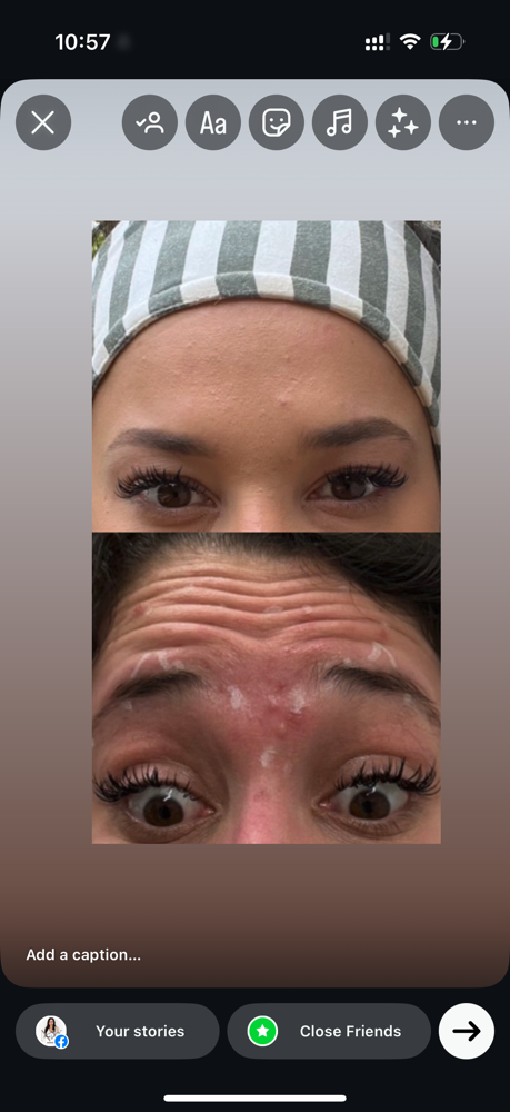 Consultation: Tox/Botox& Lip filler