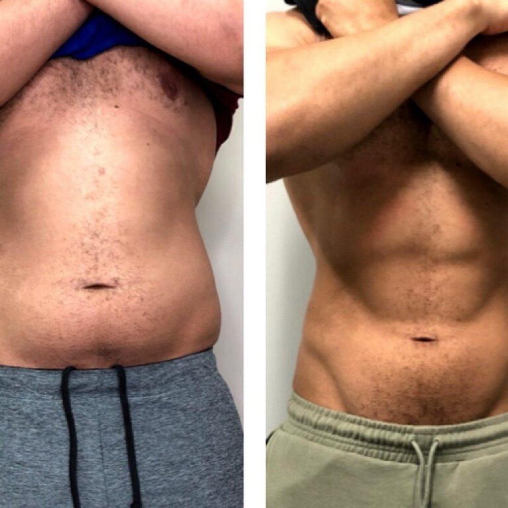 Cryo T-Shock Fat Freezing