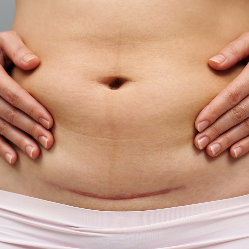 Postpartum Lymphatic Core Renewal at Brazilian Body Sculpting in San Diego, CA