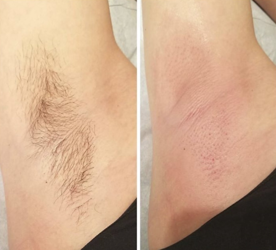 Underarm Wax