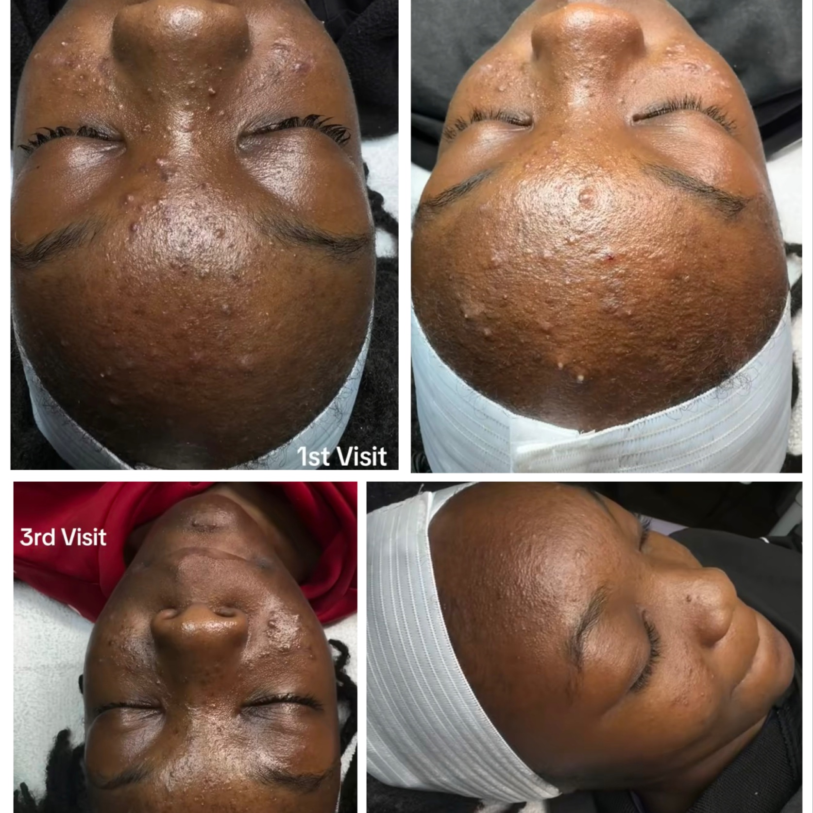 Acne Rebuild (5 Sessions) at The Complexion Parlor in Georgetown, SC