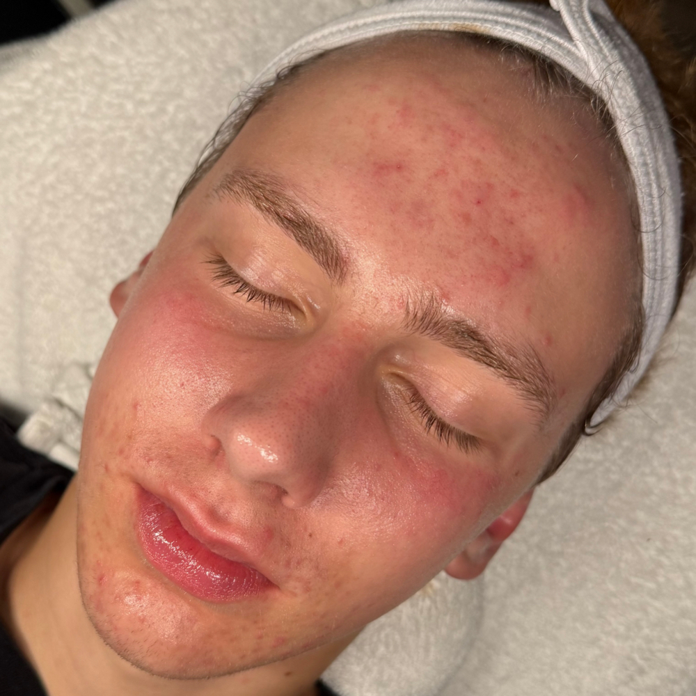 Clear & Calm Facial at True Beauty Esthetics in North Platte, NE