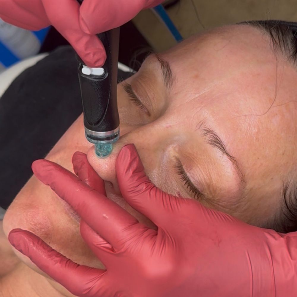 Hydrafacial Plat. by FacialFormula at Facial Formula in Costa Mesa, CA