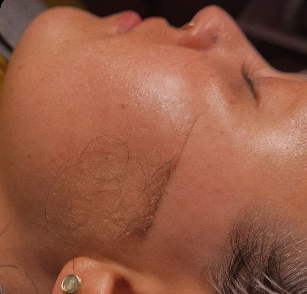 Dermaplane Facial