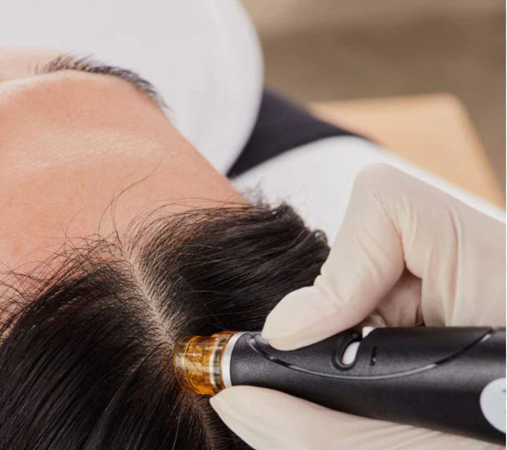 Scalp BioOxigen Therapy
