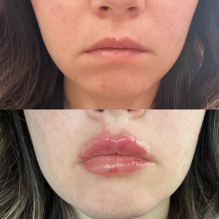Glow Boost (1/2 Syringe) at Glowtox Haus in San Antonio, TX