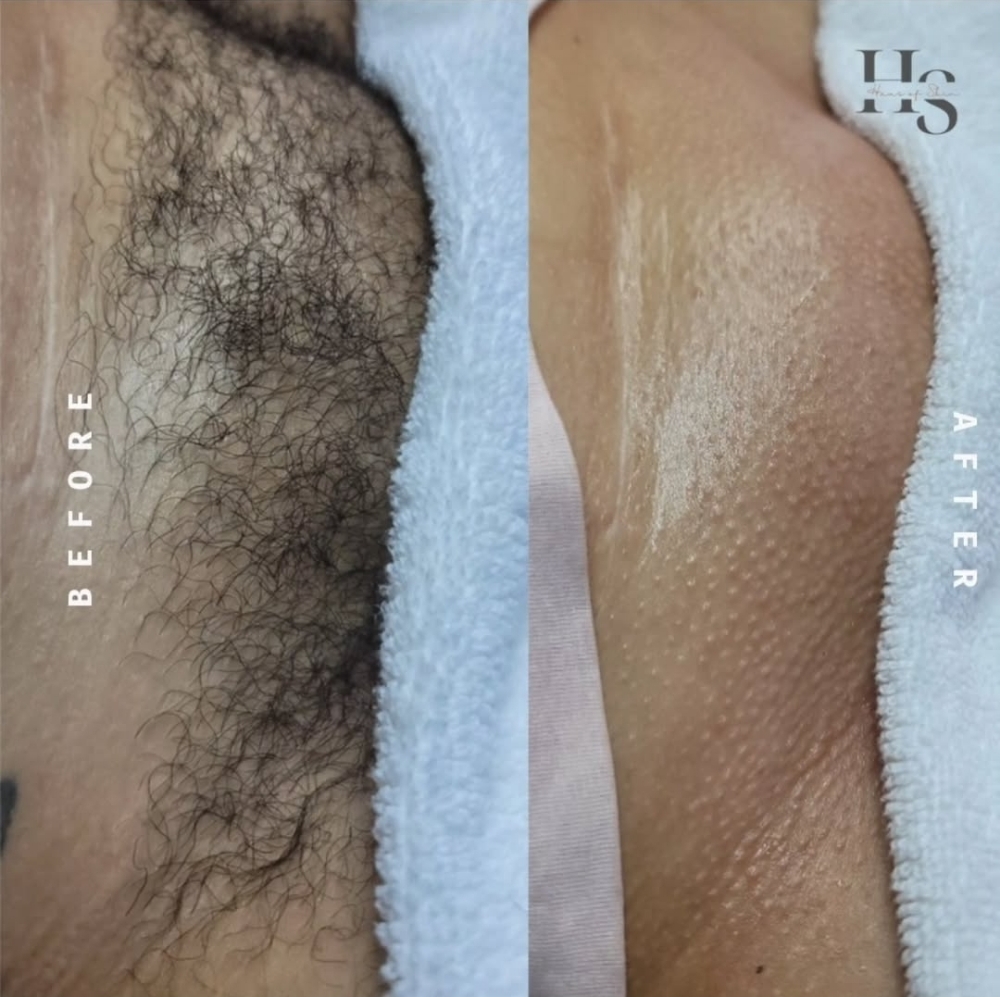 Haus Luxury Brazilian at Haus Of Skin in Burleson, TX