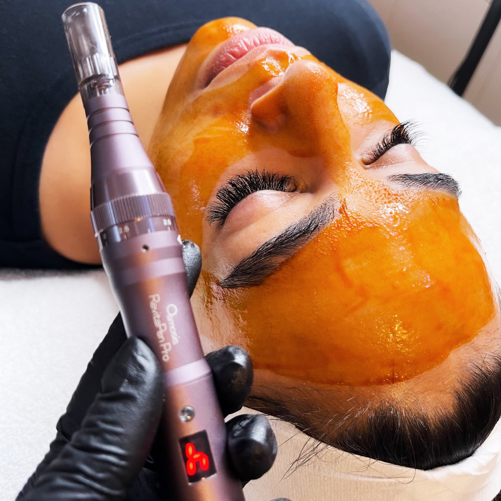 RevitaPen Facial Infusion