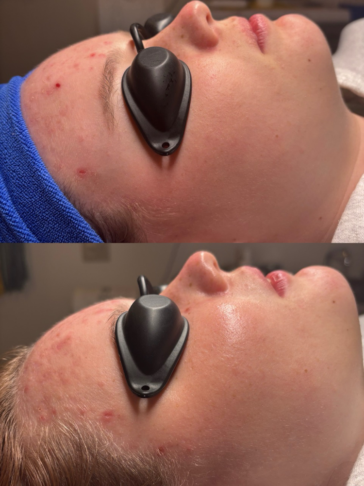 Clarifying Facial