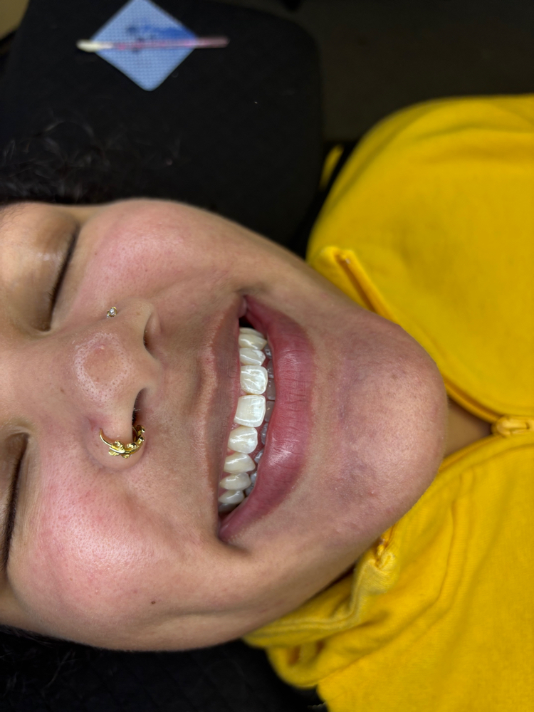 Teeth whitening