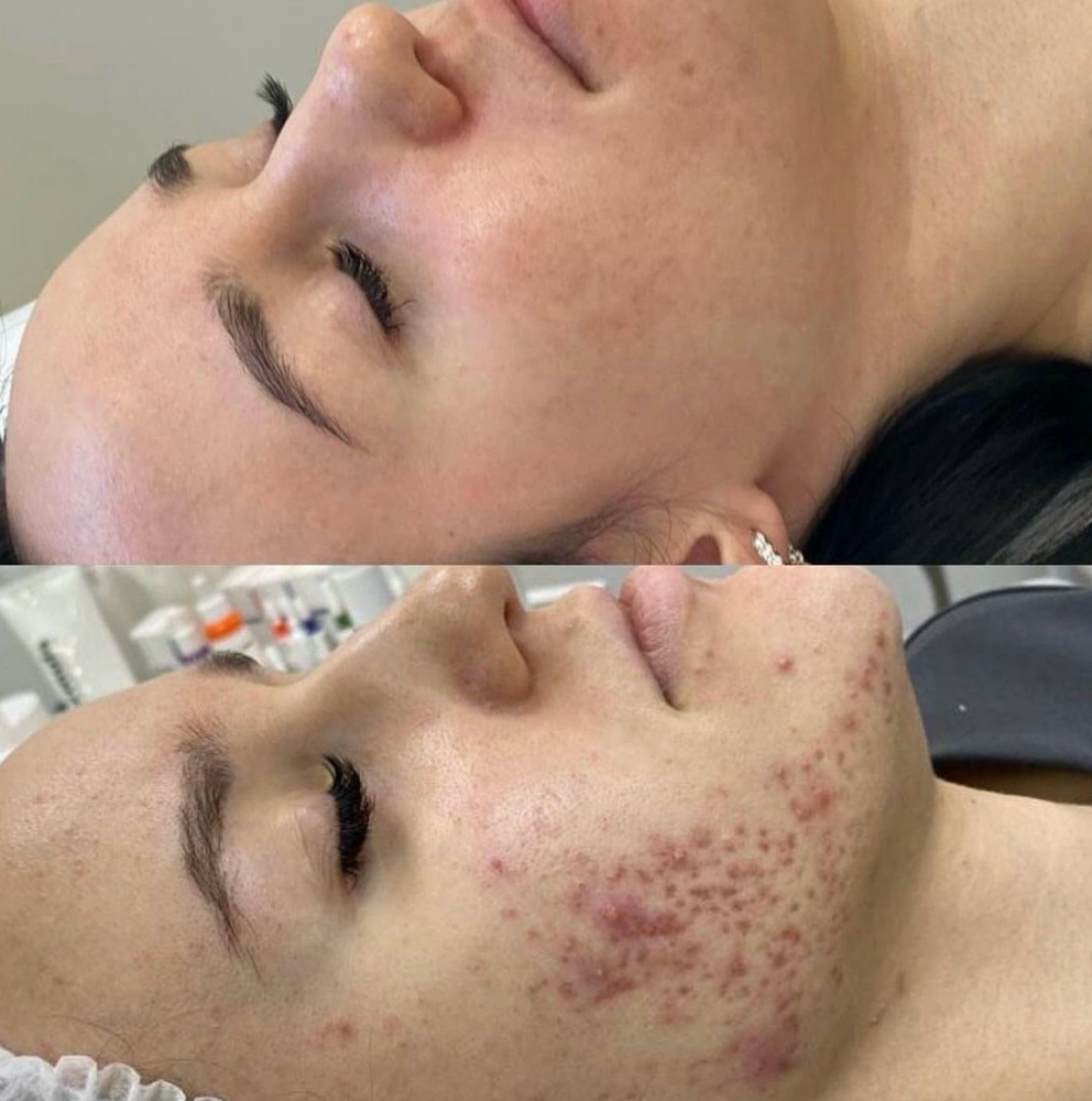 Bio Peel Treatment 🧪