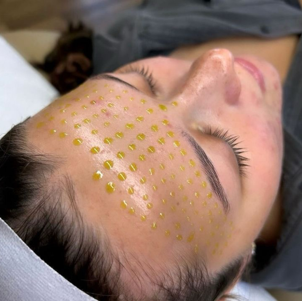 PEPTIDE INFUSION FACIAL at Vanessa Yarce in Miami, FL