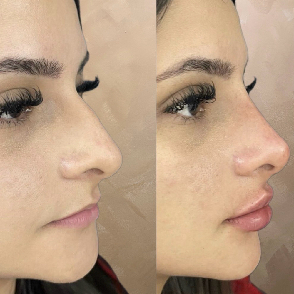 Dermal Filler at The Lash Room SLC in West Valley City, UT