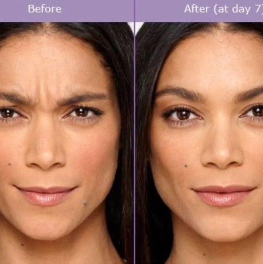 Brow Lift (Botox) at Flawless Spa & Beauty in Fort Worth, TX