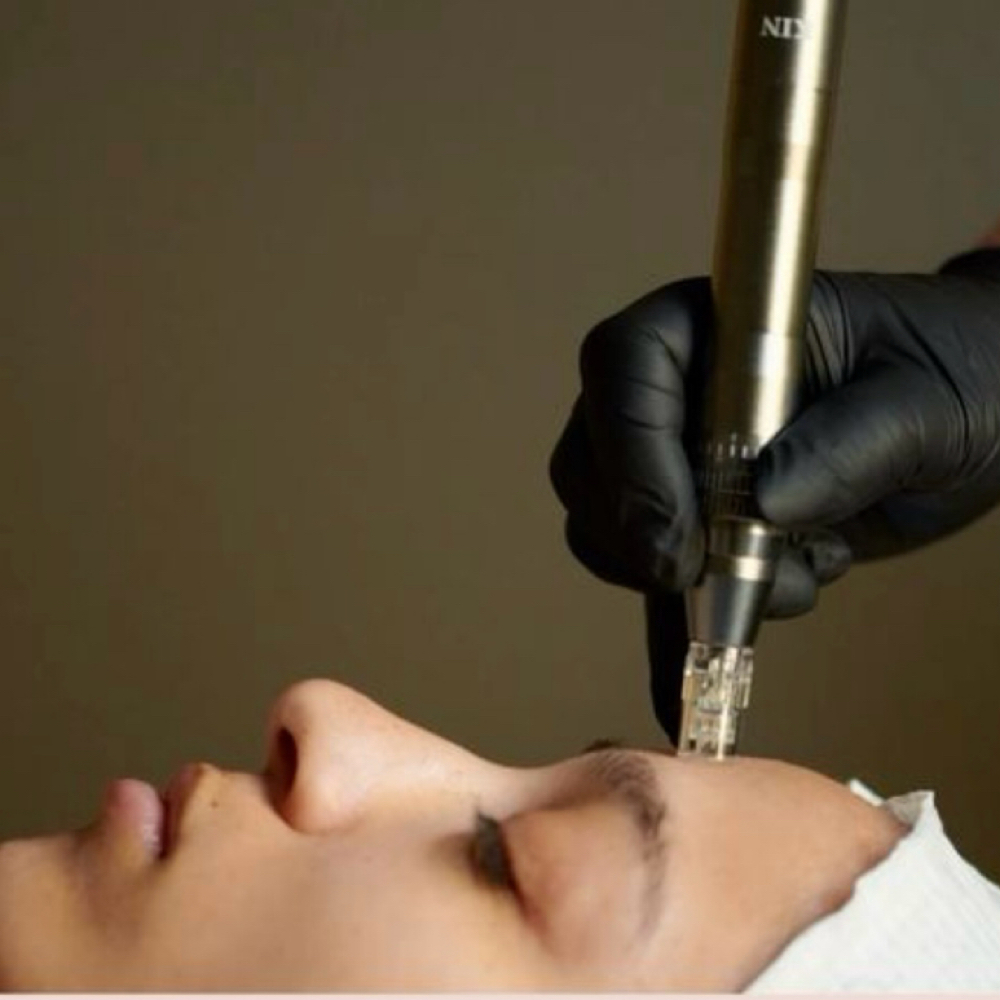 Micro-Needling at Healthy Skin Day Spa in Abilene, TX