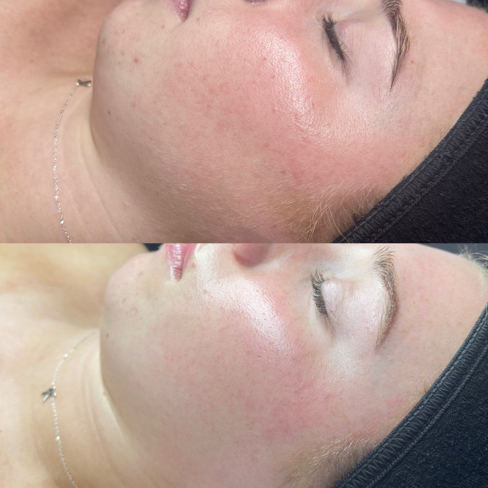 Dermaplane Glow Facial