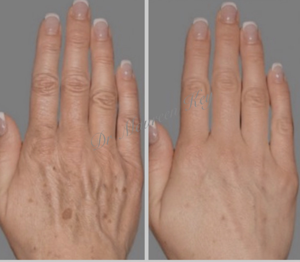Hydrodiamond Hands Treatment
