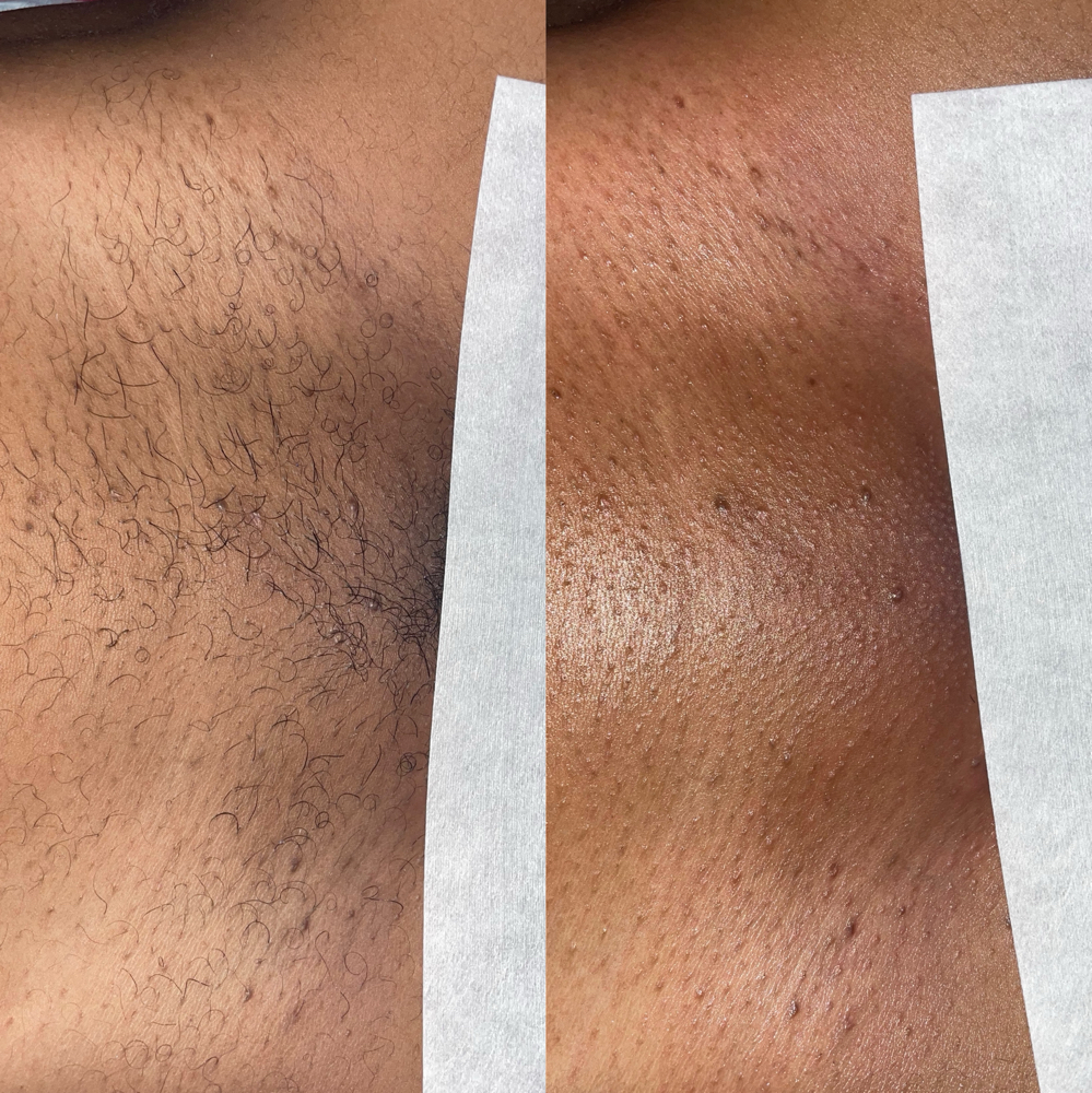 Brazilian wax at Reflective Esthetics in Hammond, LA
