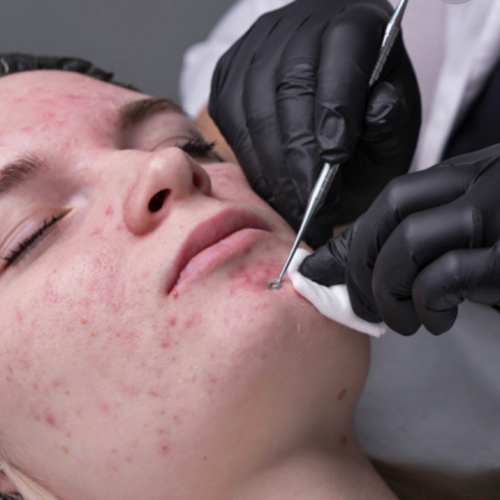 Acne Clearing Facial at Fresh Face Spa in San Diego, CA