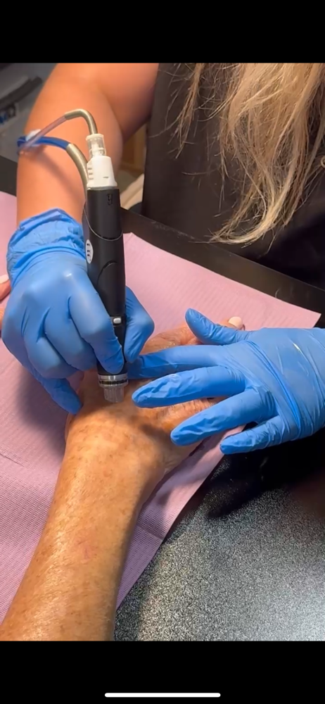 Hydrafacial Hand Treatment