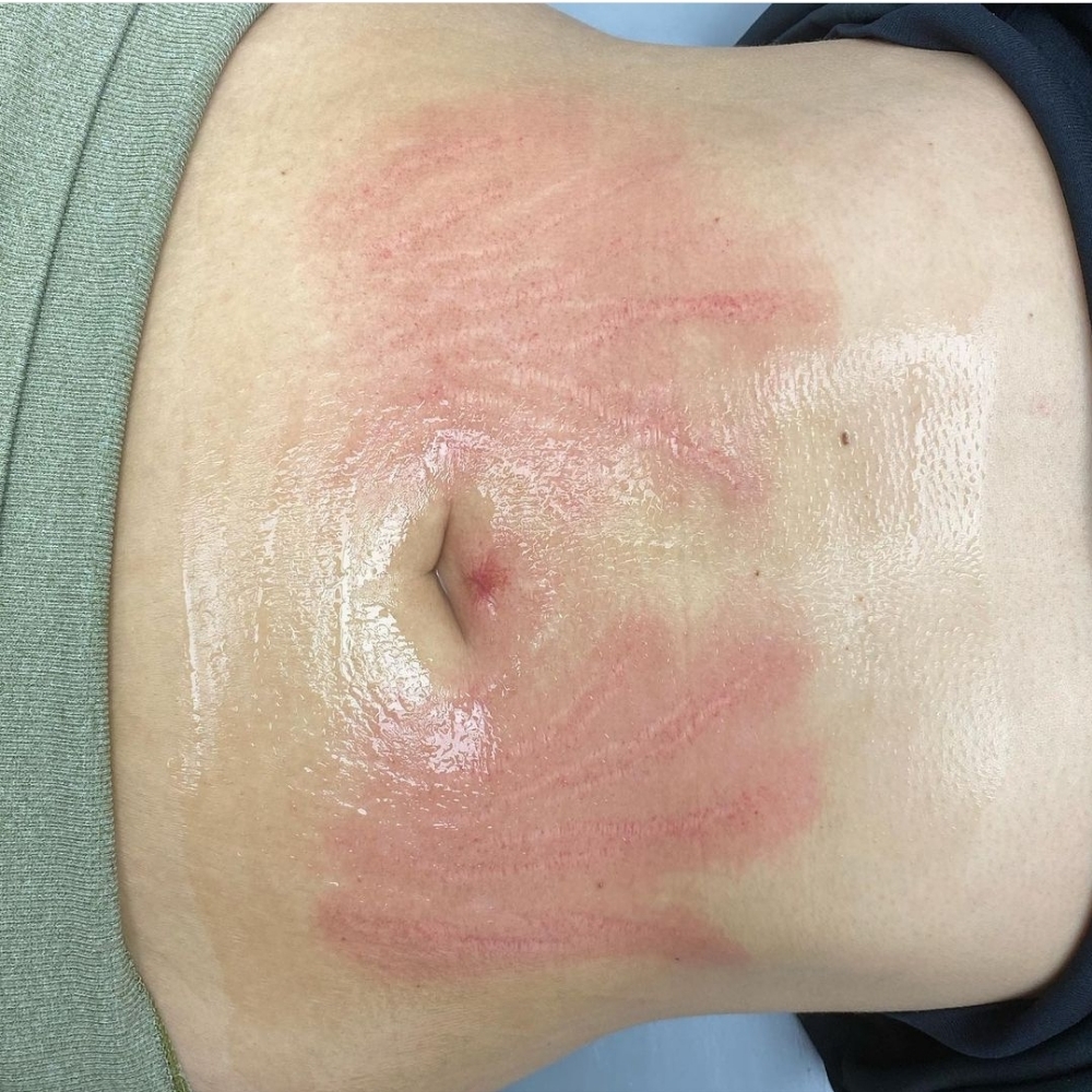 Fibroblast Strech Mark Abdomen