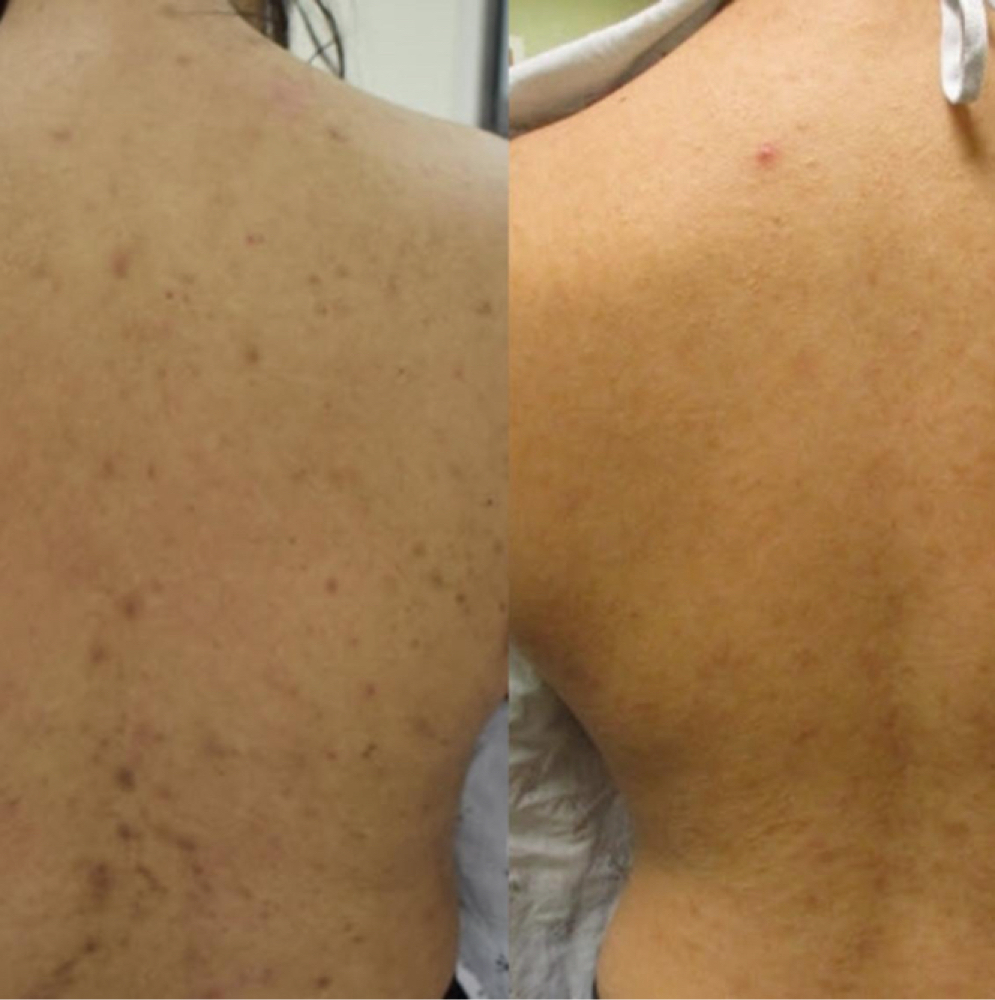 Body Chemical Peel at The Full Edit Aesthetic Studio in Florence, AL
