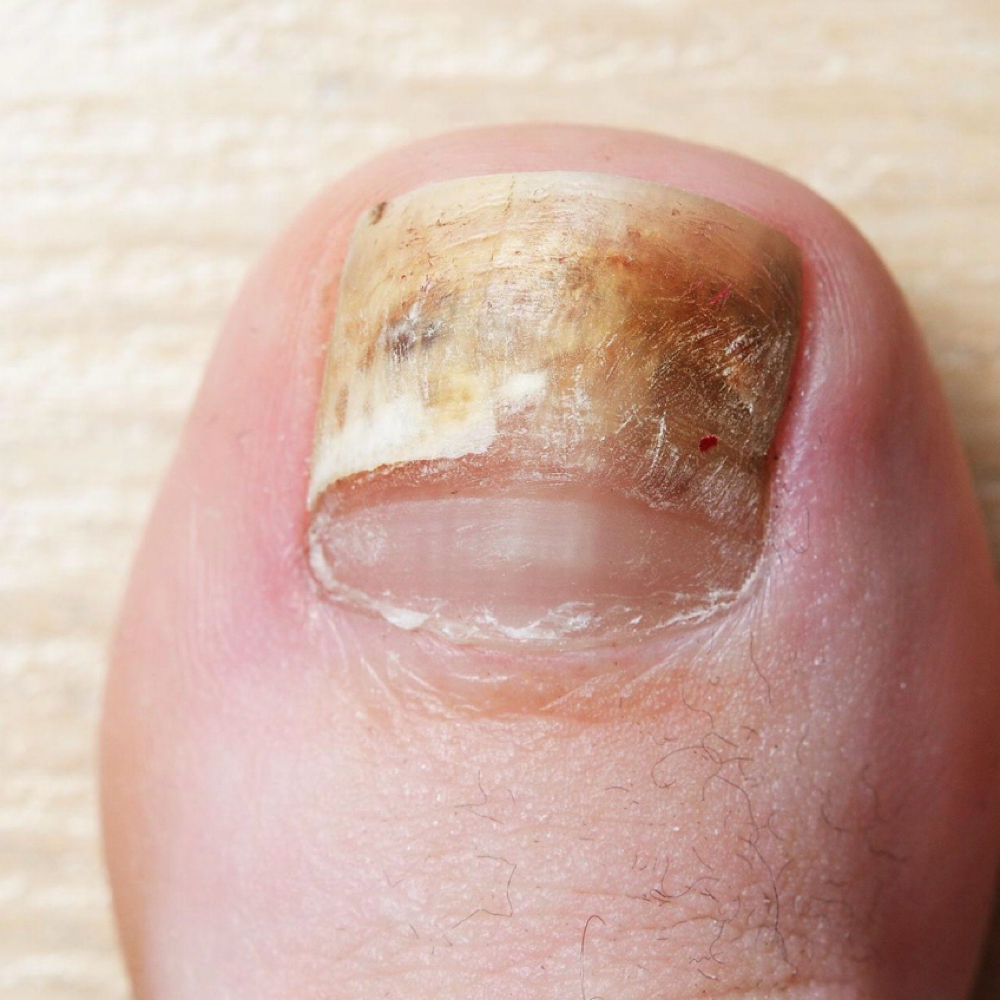 Onychomycosis-Fungus Na Unha (3) at La Belle Studio by Soraya in Woburn, MA