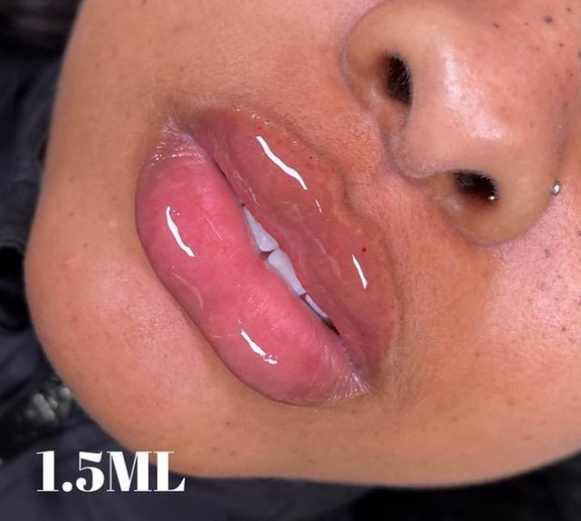 Lip Filler 1.5 (Bratz Doll Lips)👄
