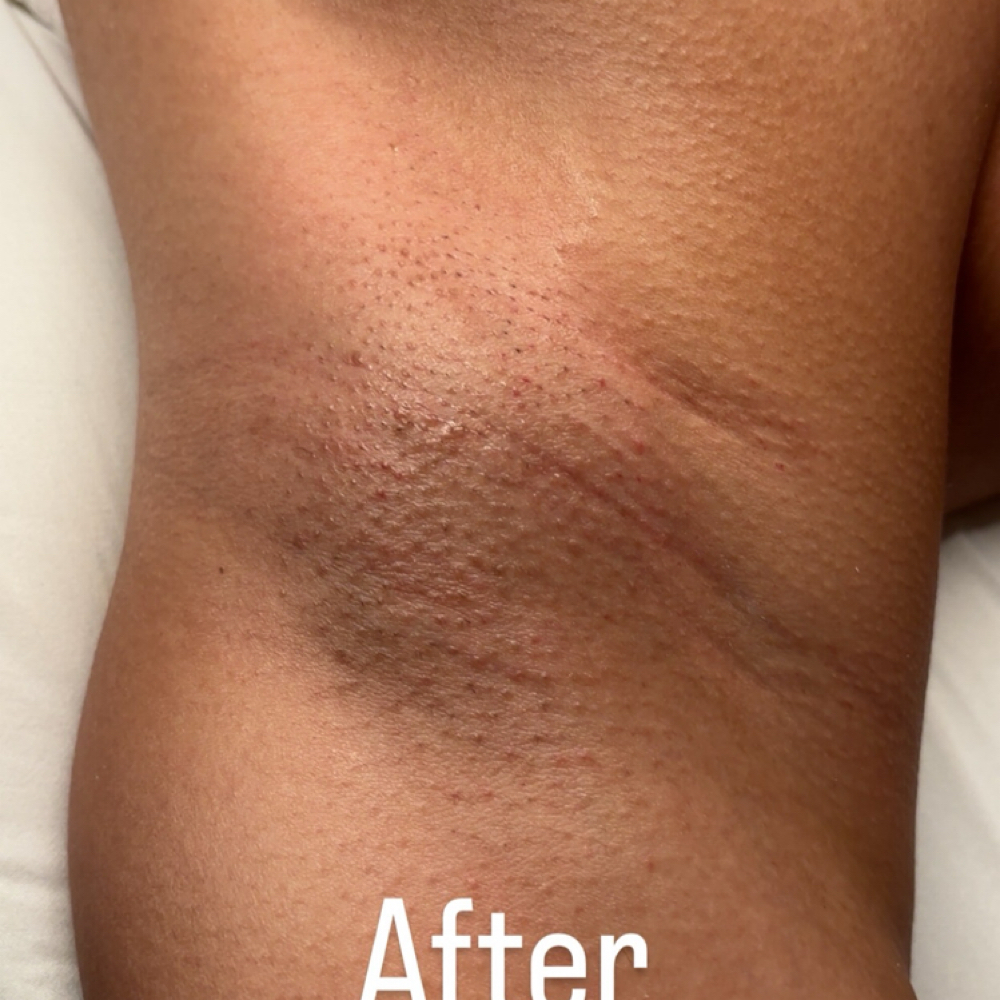 Underarm Sugar at Poppy Esthetics in Wichita Falls, TX
