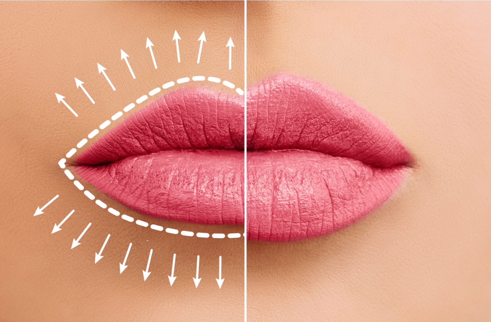 LIP FLIP (NEUROTOXIN)