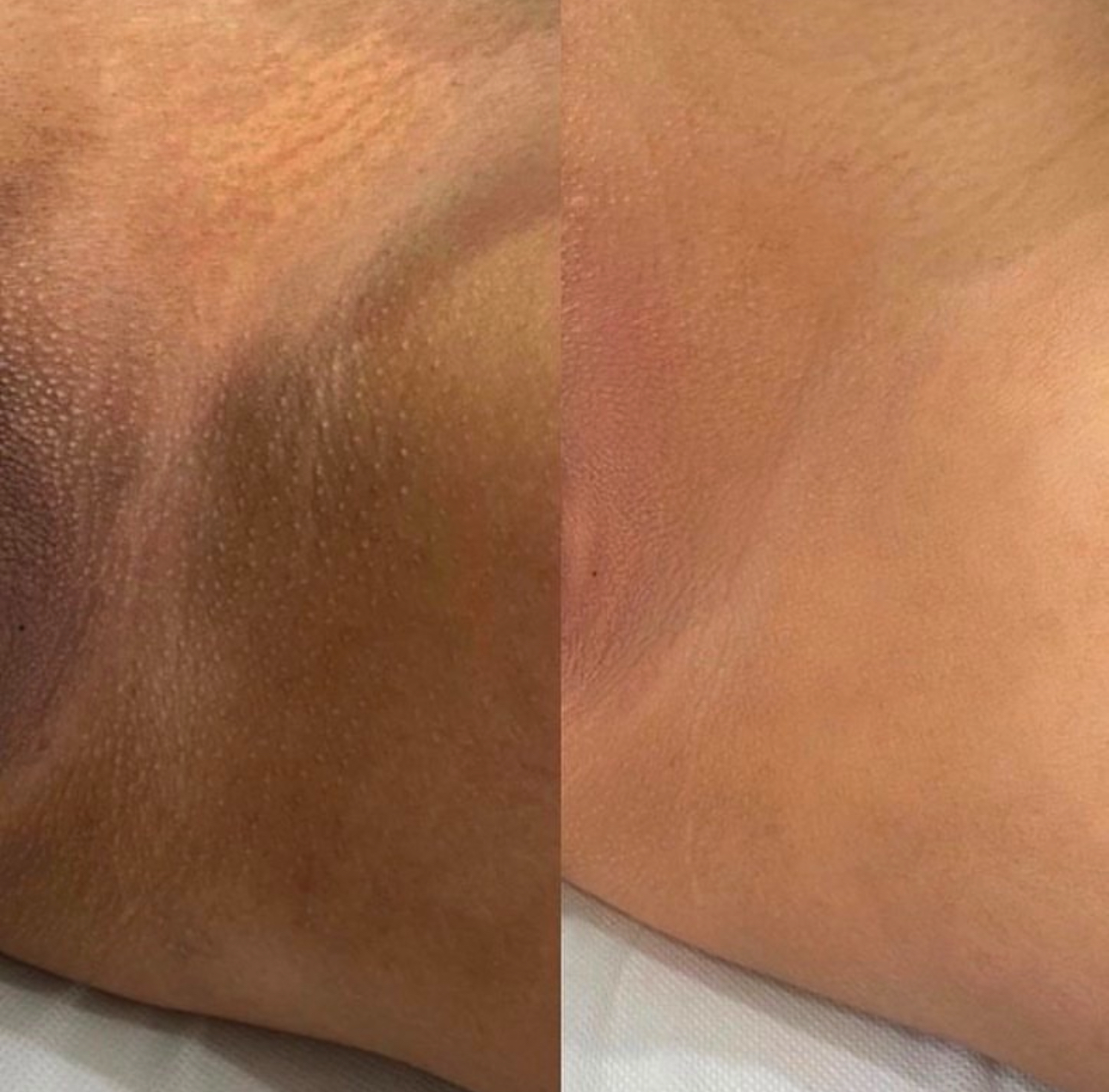 Inner Thigh Bleaching