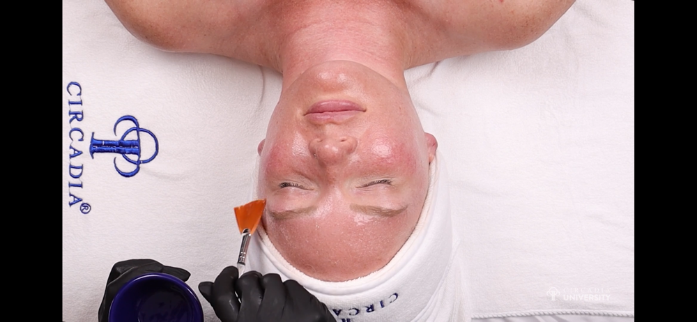 Superficial Peel Facial