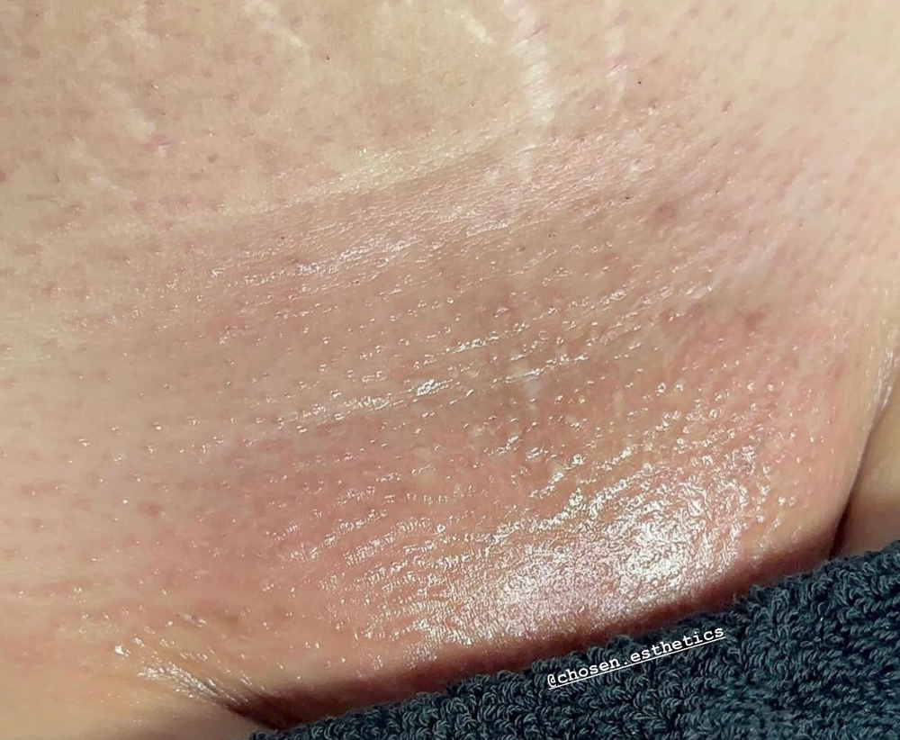 Brazilian Wax at Chosen Esthetics in Pasadena, TX