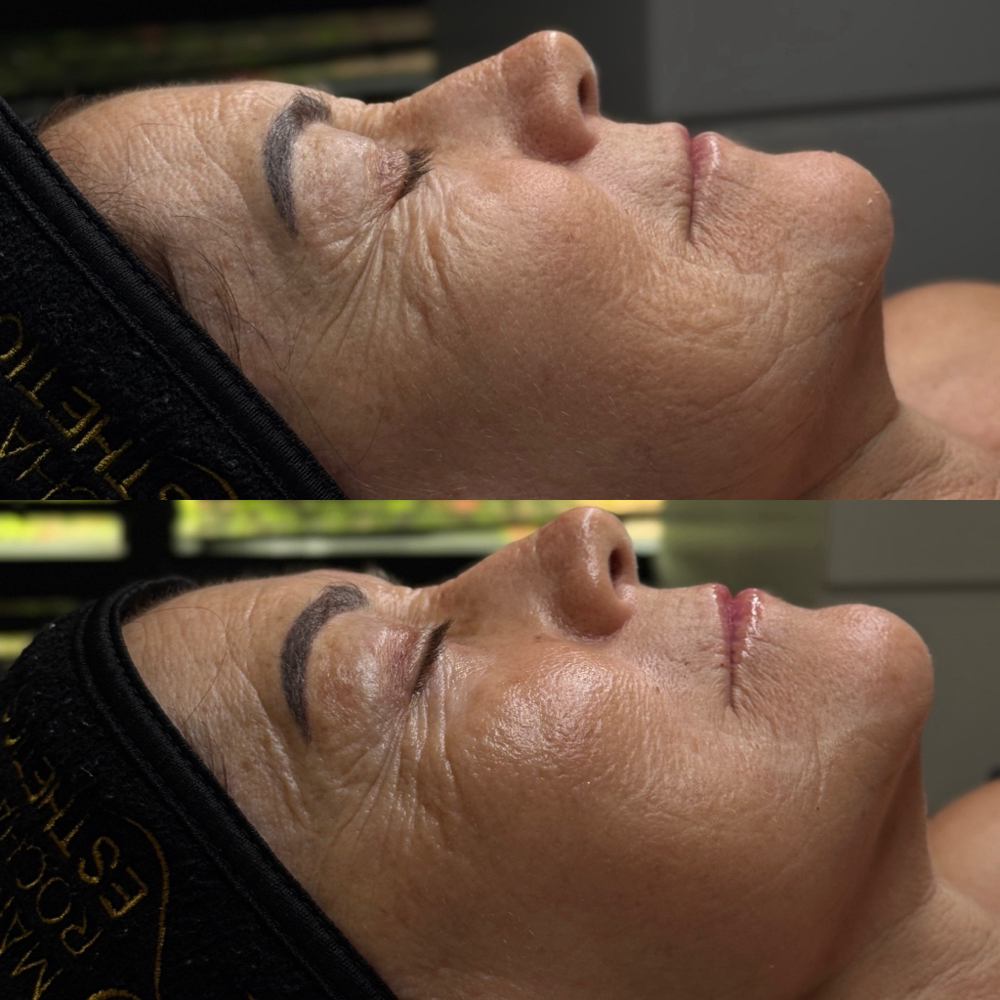 Luxe lift facial at Marina Rocha Esthetics in Greensboro, NC