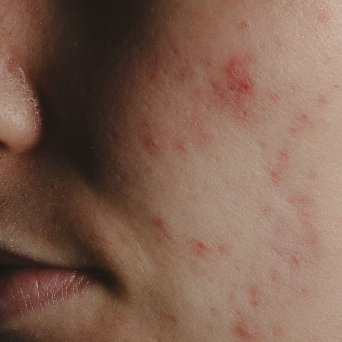 The Acne Reset | Peel + Extractions at Honeyveil Esthetics in Columbus, IN