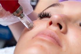 MICRONEEDLING