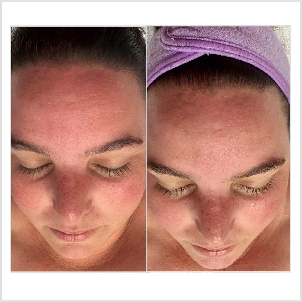 Rosacea Treatment