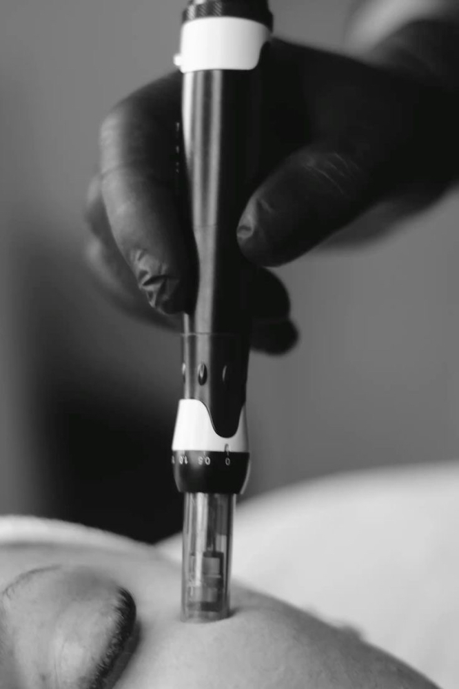 Microneedling
