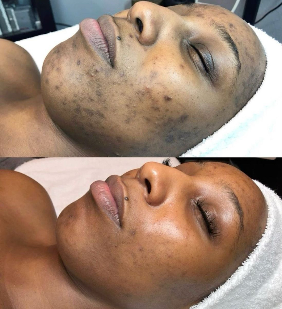 Chemical Peel