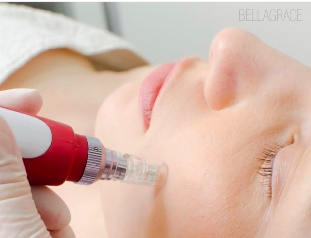 CIT (Microneedling)