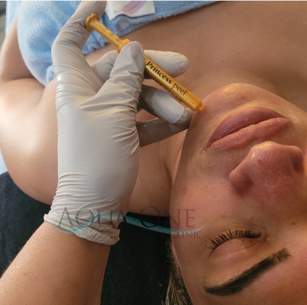 BioMicroneedling Level 1