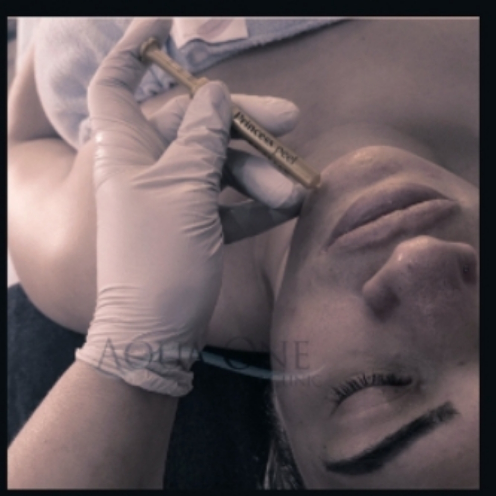 BioMicroneedling Level 1 at Aqua One Skin Clinic in Jasper, IN