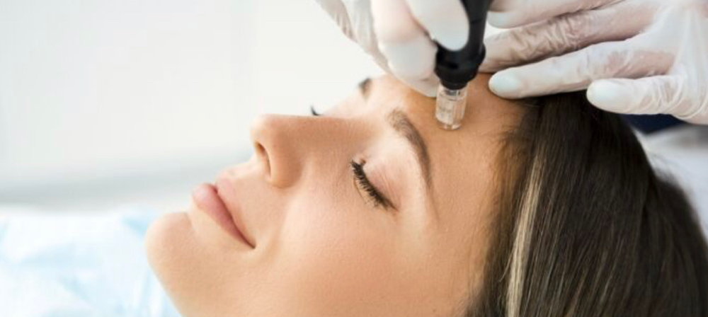 MICRONEEDLING SKIN TREATMENT!