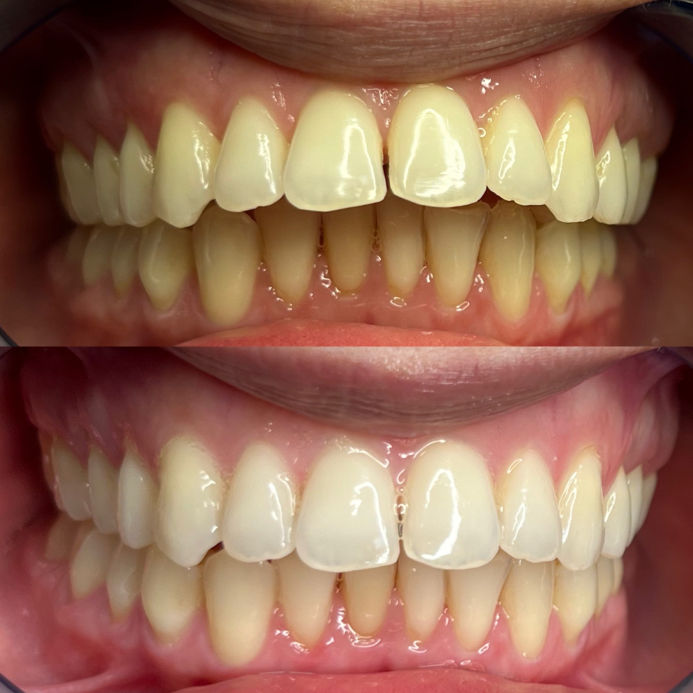 Teeth Whitening 60 Min