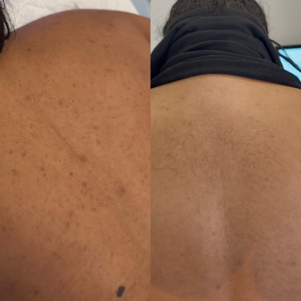 Back Depigmentation Peel at The Derma House in phoenix, AZ