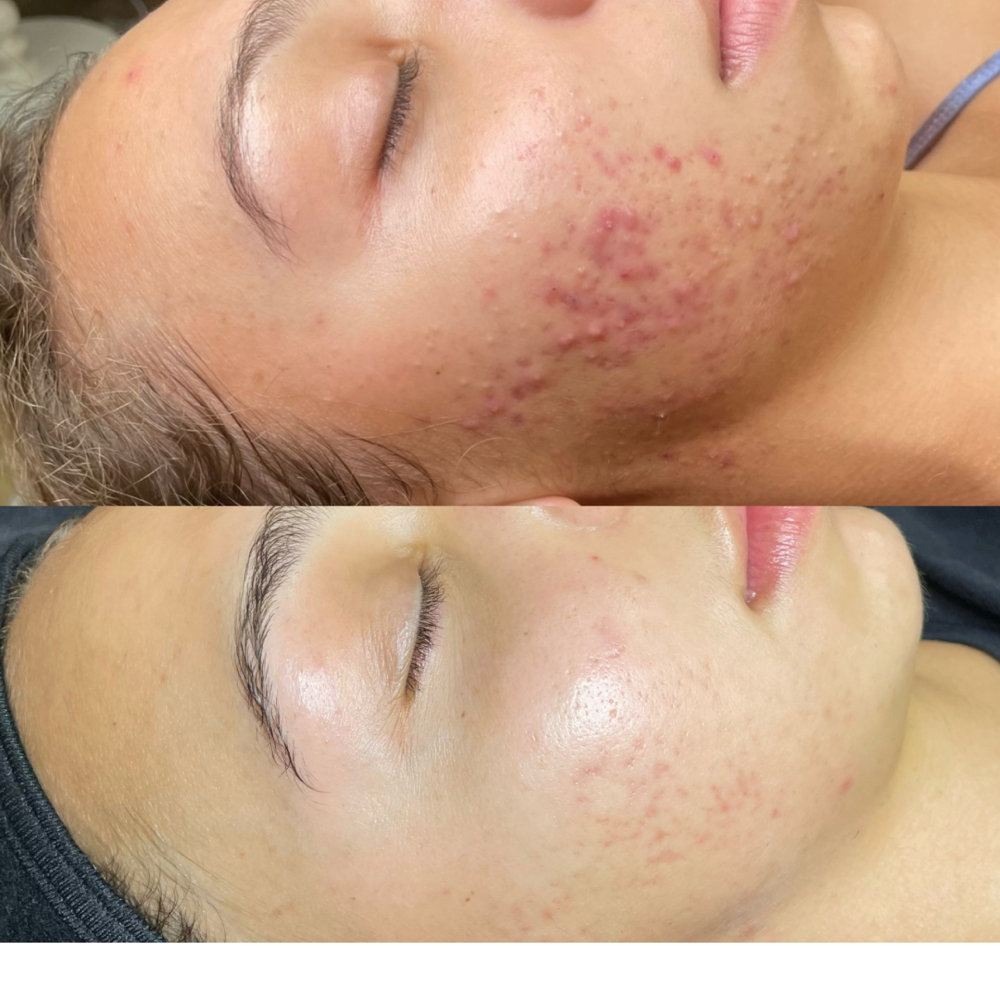 Acne Bootcamp Treatment