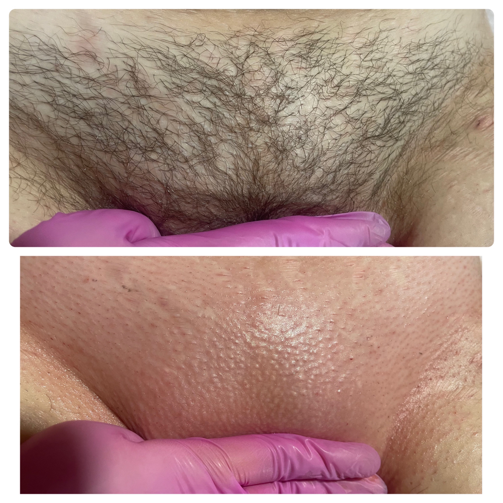 Brazilian Wax