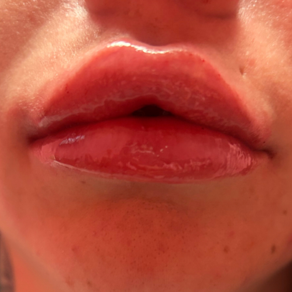 Elasty/Remula/VOM Lip Fillers at Finesse Sculpt Body Studio in Parkville, MD