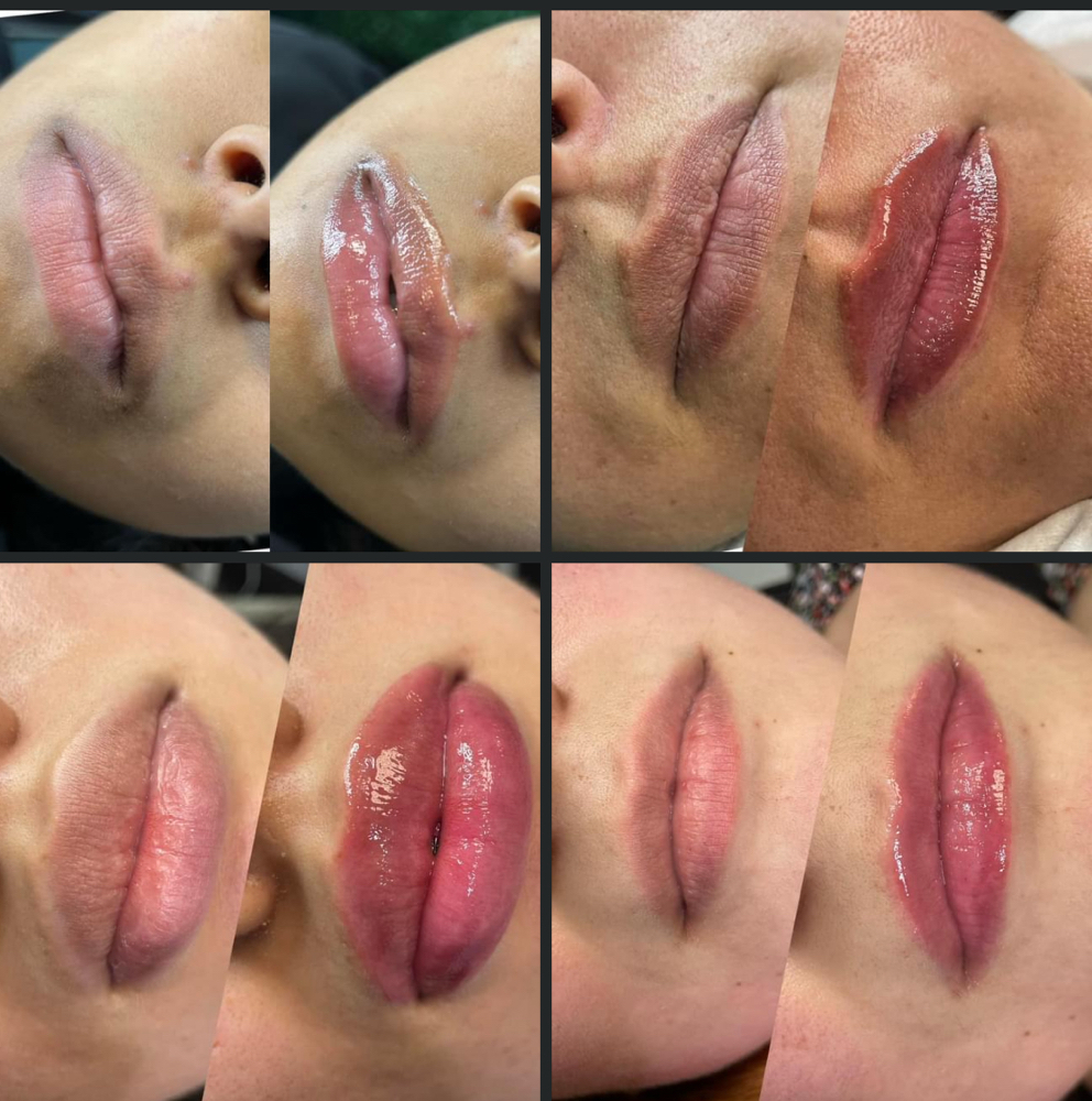 Hydra Lips at Anointed Aesthetics in Pasadena, TX